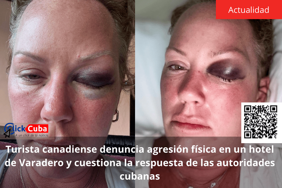 Turista canadiense denuncia agresión física en un hotel de Varadero y cuestiona la respuesta de las autoridades&nbsp;cubanas