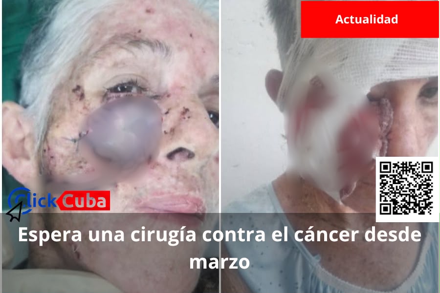 «Mi mamá empeora cada día más»: una cubana de 67 años con cáncer espera desde marzo una cirugía que no llega